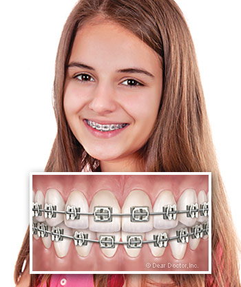 Types of Braces