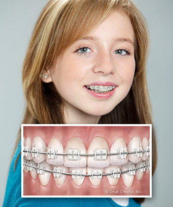 Types of Braces