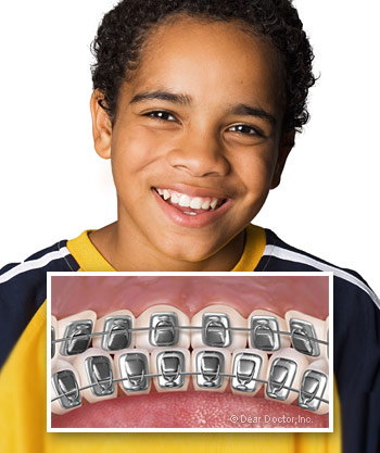 Types of Braces